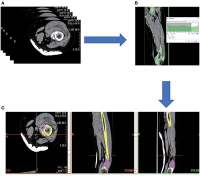 Application of Finite Element Analysis Combined With Virtual Computer in Preoperative Planning of Distal Femoral Fracture